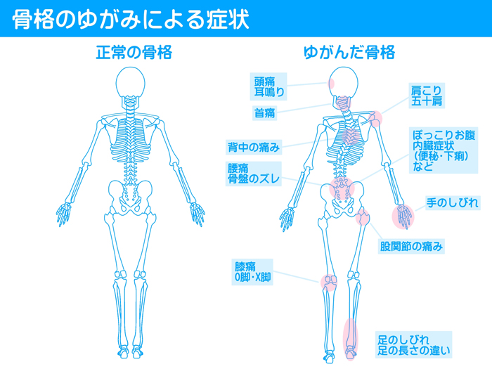 サブラクセーションとは? サブラクセーションとは?